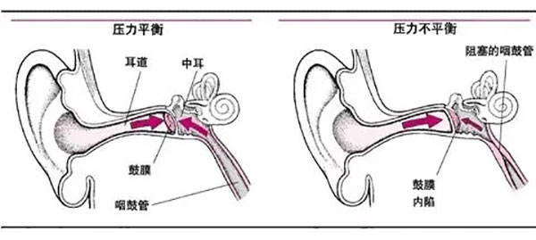 为什么感冒容易引起中耳炎？这些知识点你得了解！