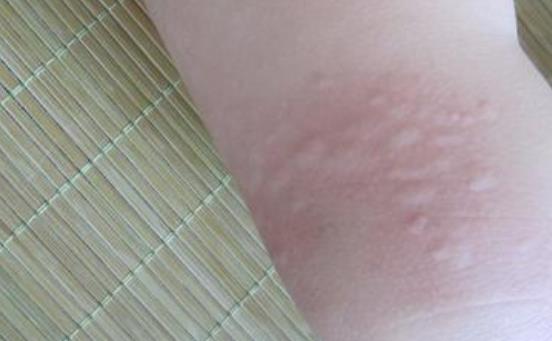 什么是皮肤过敏？哪些水果容易引起过敏？