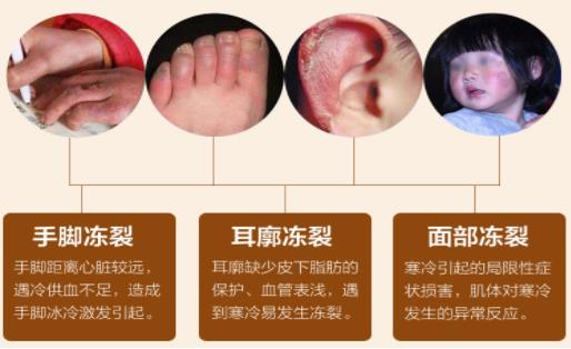 冬天脚长冻疮应该涂什么冻疮膏管用 手脚冻疮怎么治疗好得快