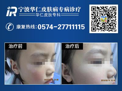 宁波白癜风医院：孩子是白癜风易发群体吗？123123