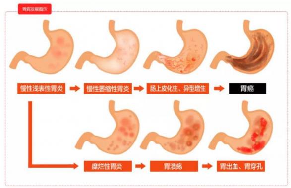 很多人不听劝,没多久查出了胃癌……很多悲剧,几乎每天上演! 呼市东大肛肠医院