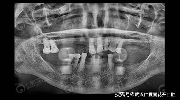 武漢仁愛(ài)口腔ALL-ON-6即拔即種即刻修復(fù)，當(dāng)天種牙當(dāng)天用！