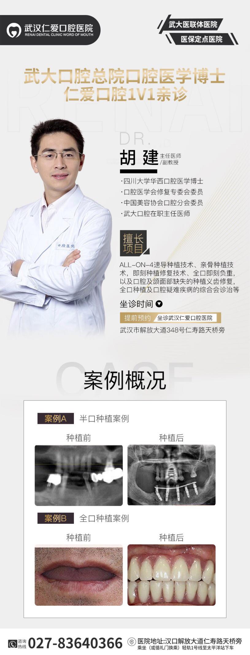 武漢仁愛(ài)口腔ALL-ON-6即拔即種即刻修復(fù)，當(dāng)天種牙當(dāng)天用！
