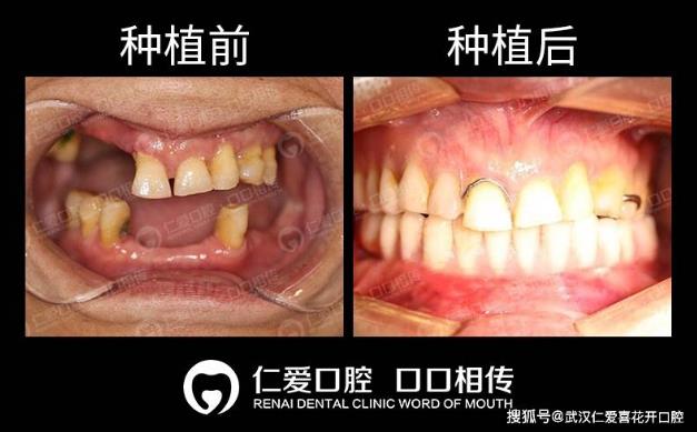 武漢仁愛(ài)口腔ALL-ON-6即拔即種即刻修復(fù)，當(dāng)天種牙當(dāng)天用！