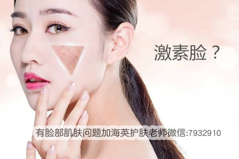 激素脸潮红多久能好？激素脸擦什么好？