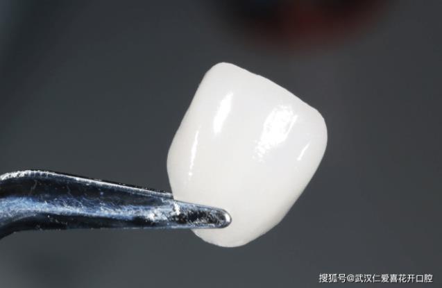 效果如何？ 武汉仁爱口腔医院贴面技术怎样