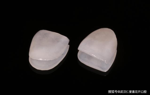 效果如何？ 武汉仁爱口腔医院贴面技术怎样