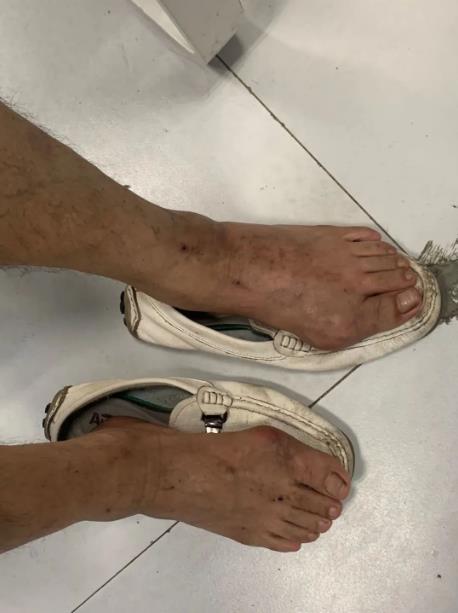 轻度痛风石临床表现有哪些?成都西部痛风风湿医院来解析