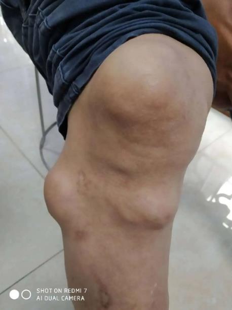 轻度痛风石临床表现有哪些?成都西部痛风风湿医院来解析
