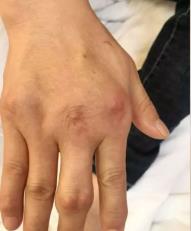 轻度痛风石临床表现有哪些?成都西部痛风风湿医院来解析