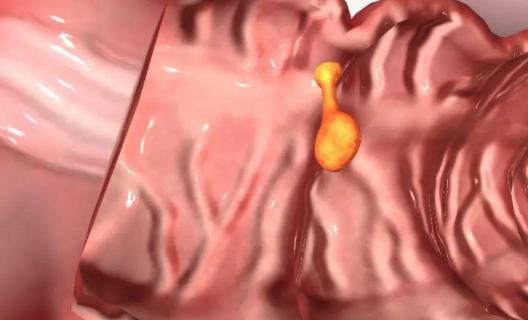 大肠息肉有哪些症状?怎么预防大肠息肉?