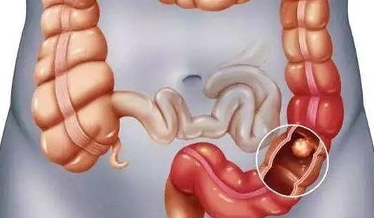 大肠息肉有哪些症状?怎么预防大肠息肉?