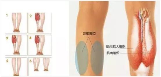 北京伊美尔爱康医院:瘦肩针的成分是什么?