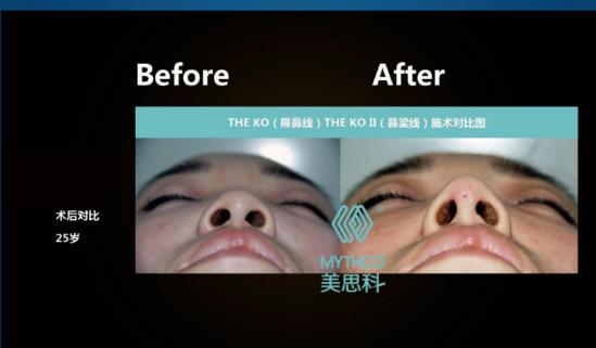 MYTHCO美思科線雕效果怎么樣？跟美思科蛋白線有什么區(qū)別？