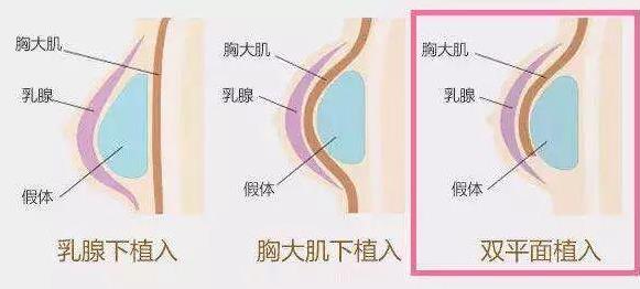 昆明想做假体隆胸,要怎么选择?