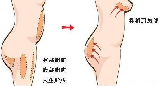 昆明想做假体隆胸,要怎么选择?