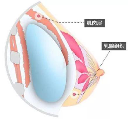 昆明想做假体隆胸,要怎么选择?