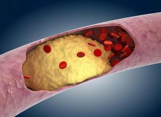 轻症急性胰腺炎会有后遗症吗?重症急性胰腺炎有救吗