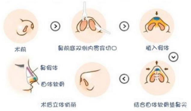 个性定制 泉州欧菲整形医院做双眼皮好不好?安全塑美