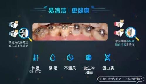 托槽掉了怎么办？球托舒适化矫正了解一下！