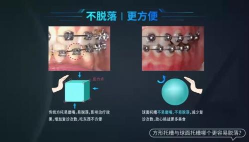 托槽掉了怎么办？球托舒适化矫正了解一下！