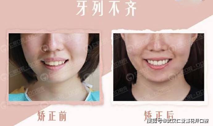 正畸改善凸嘴,契合审美“E线” 武汉仁爱口腔隐适美案例