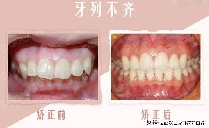 正畸改善凸嘴,契合审美“E线” 武汉仁爱口腔隐适美案例
