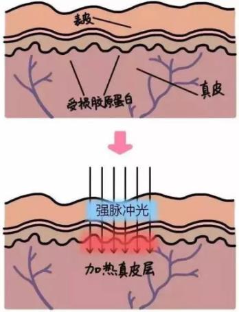 北京伊美爾紫竹醫院：光子嫩膚多久做一次