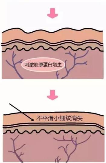 北京伊美爾紫竹醫院：光子嫩膚多久做一次