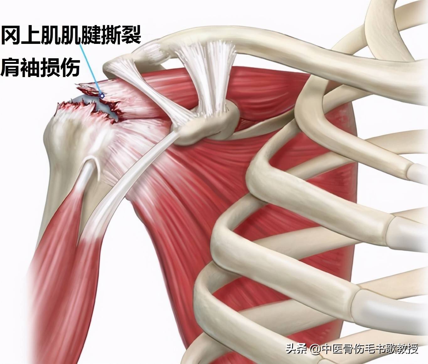 肩周炎是哪个部位痛图 肩周炎怎么办