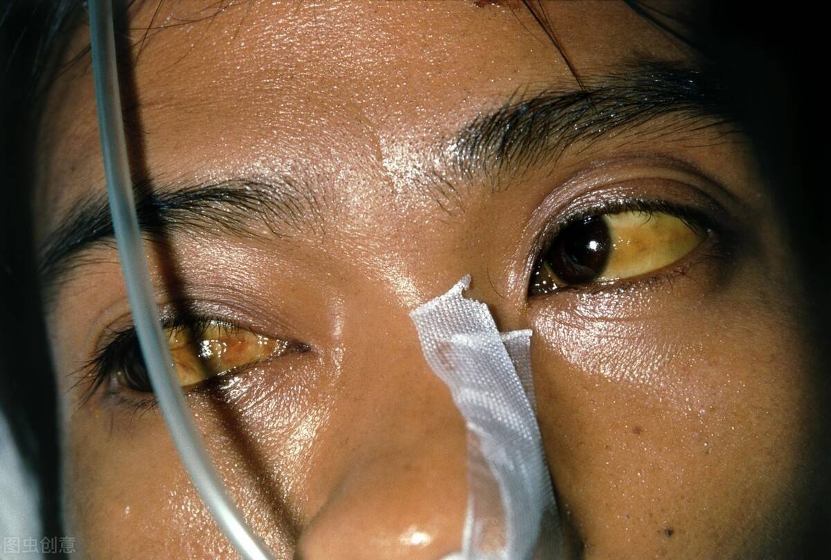 肝病最典型的几个症状 得了肝病的症状