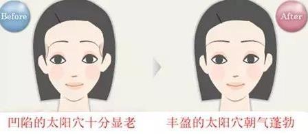 如何填充面颊凹陷?面颊部填充都有哪些填充材料