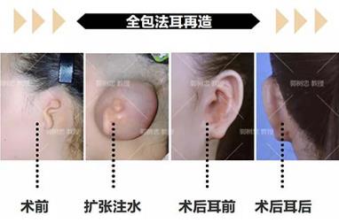 七十四 郭树忠:小耳畸形全包法的优势与不足