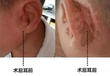 七十四 郭树忠:小耳畸形全包法的优势与不足