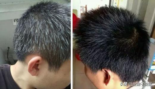 為什么頭上白頭發越來越多，是不是身體里缺什么了？該如何治療？