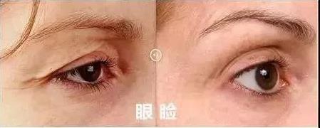 北京伊美尔健翔医院:肉毒素可以去皱吗