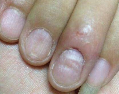 从指甲的形态和颜色就能看出身体状况 白斑就是缺钙