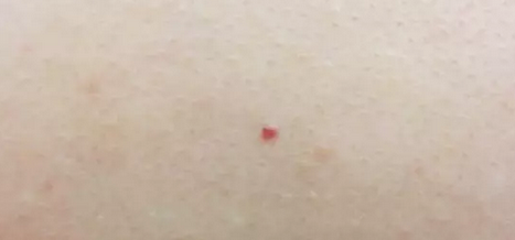 血管痣预示疾病衰老吗 和蜘蛛痣一样吗