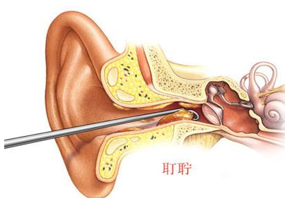 耳屎越掏越多吗 如何正确掏