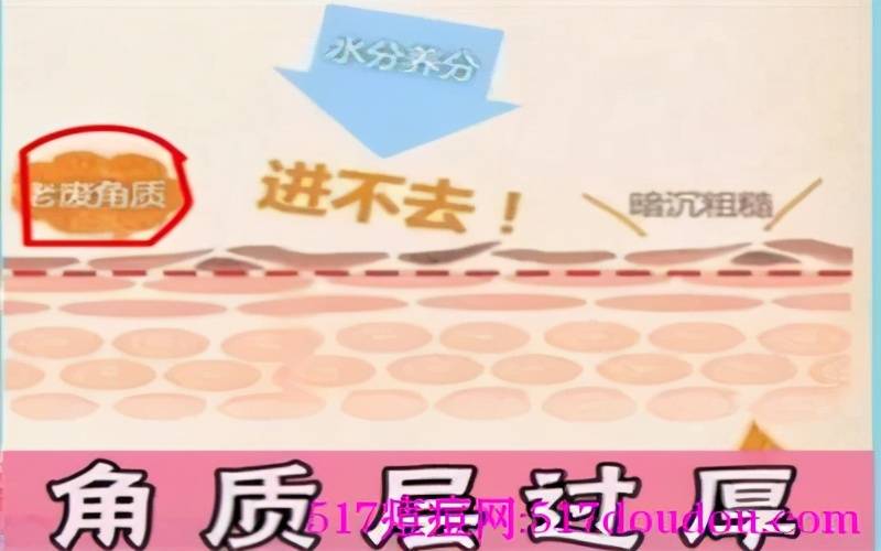 去除闭合性粉刺小妙招 封闭性粉刺怎么治疗