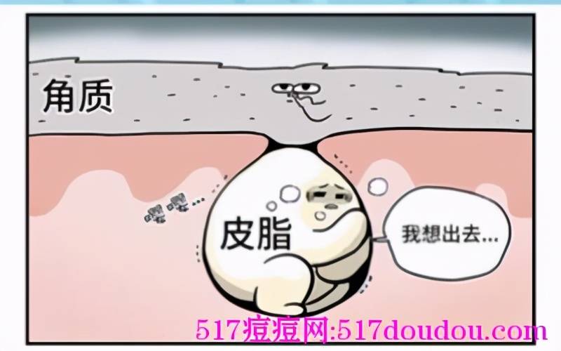 去除闭合性粉刺小妙招 封闭性粉刺怎么治疗