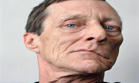 面瘫的原因及症状 如何治疗