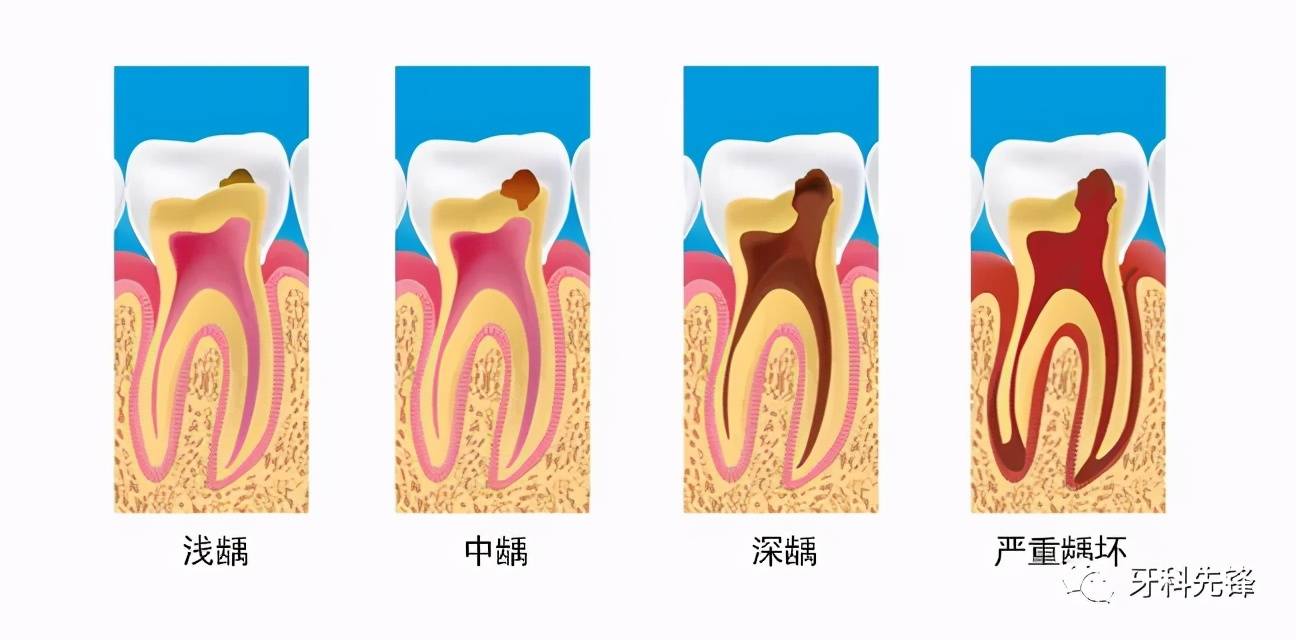 牙髓炎可以保留活髓吗 牙髓炎如何治疗