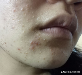 后背病毒性软疣是怎么引起的 软疣是怎么引起的