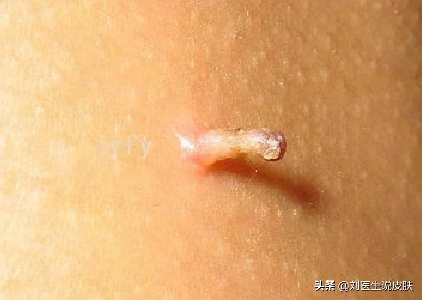 后背病毒性软疣是怎么引起的 软疣是怎么引起的