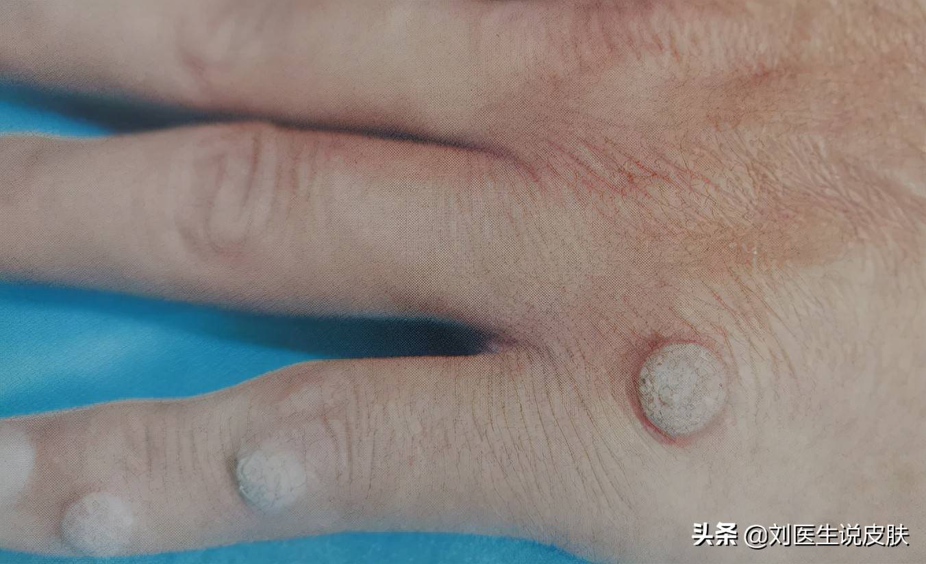 后背病毒性软疣是怎么引起的 软疣是怎么引起的
