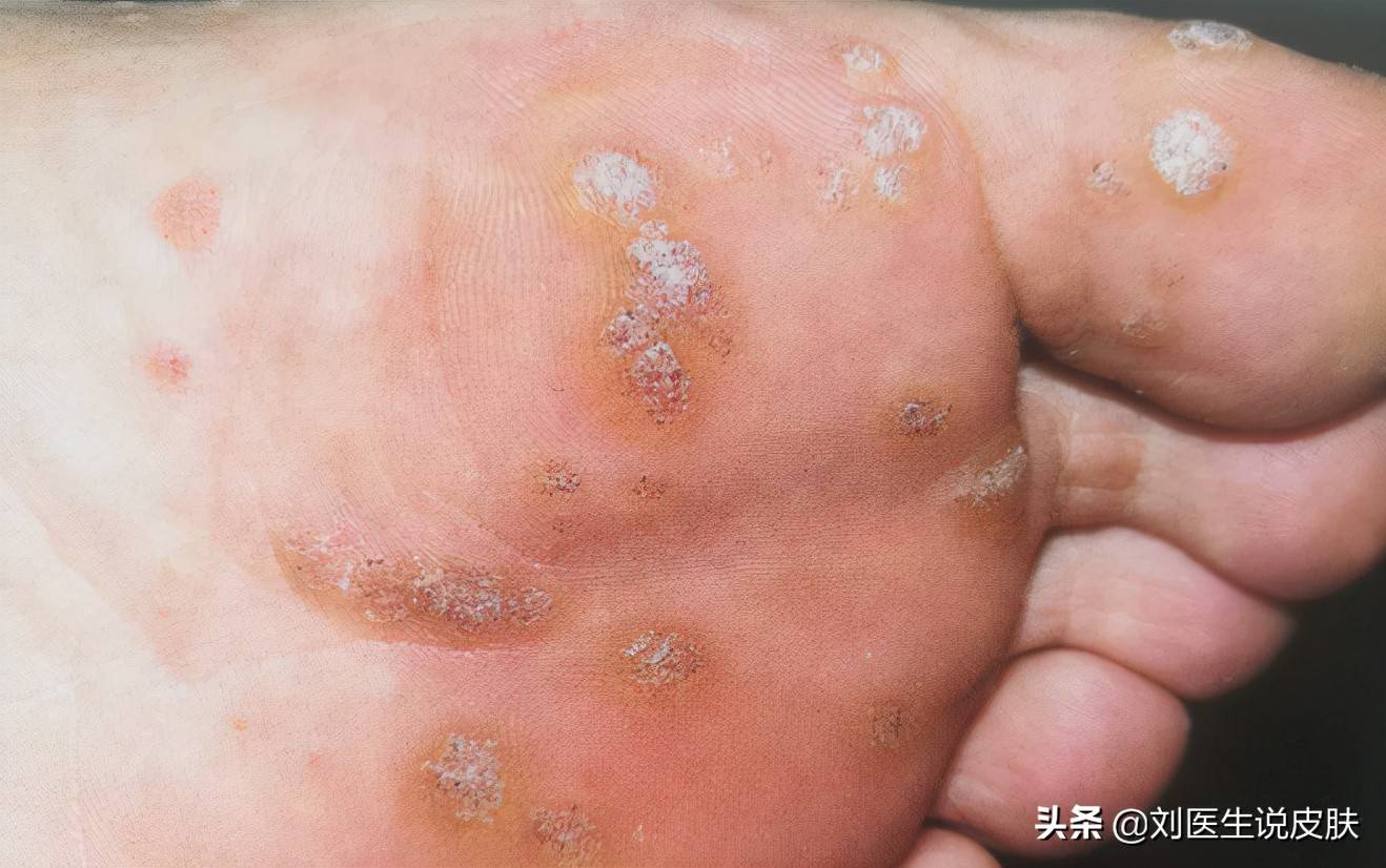 后背病毒性软疣是怎么引起的 软疣是怎么引起的