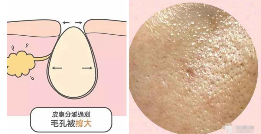 教你2个收缩毛孔的方法 有效收缩毛孔