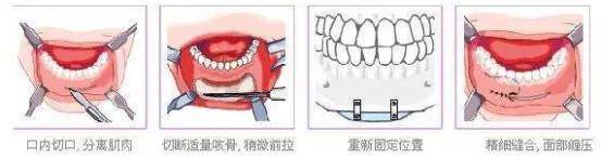 隆下巴的方式有哪些？ 双下巴整形