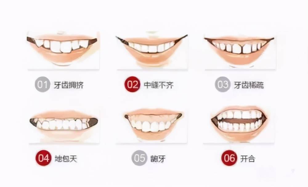 上牙槽骨突出怎么改善 牙槽骨突出怎么矫正